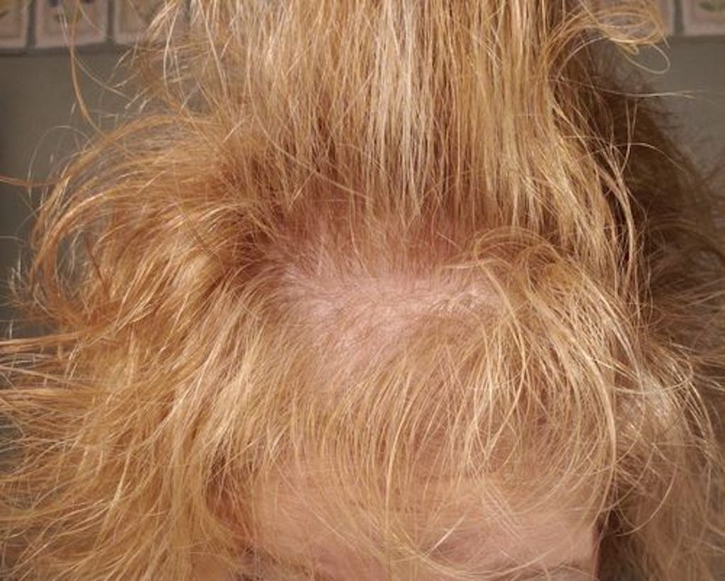 FoliGrowth Ultra Hair Growth Vitamin with high potency Biotin