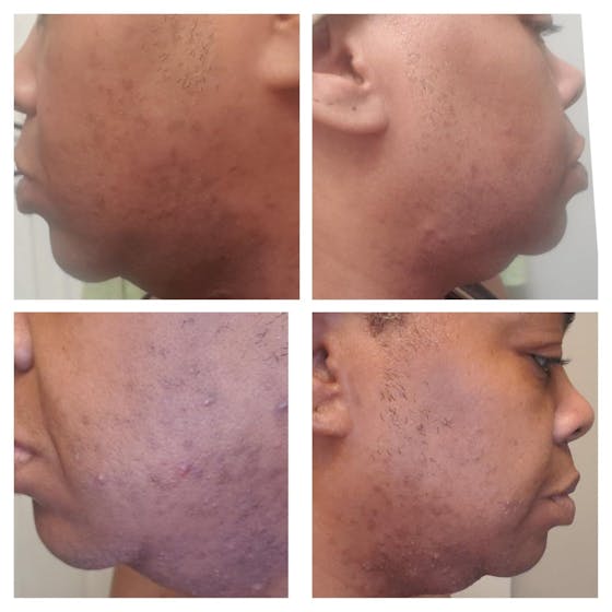 Kojic Acid Dark Spot Remover Soap Bars (2 Pack)