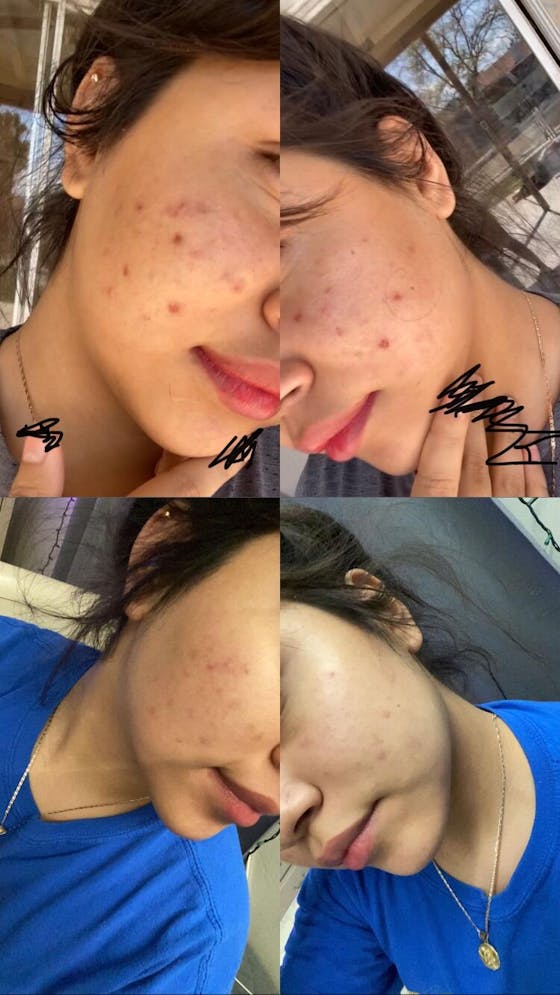 Kojic Acid Dark Spot Remover Soap Bars (2 Pack)