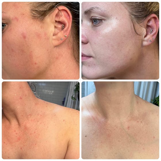 Natural Classic Kojic Acid Handmade Soap (2 Pack)