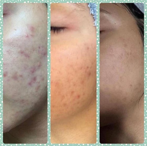 Turmeric Kojic Acid Handmade Soap (2 Pack)