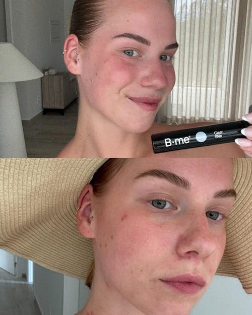 Clear skin