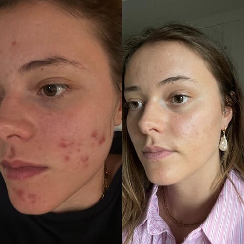 Clear skin