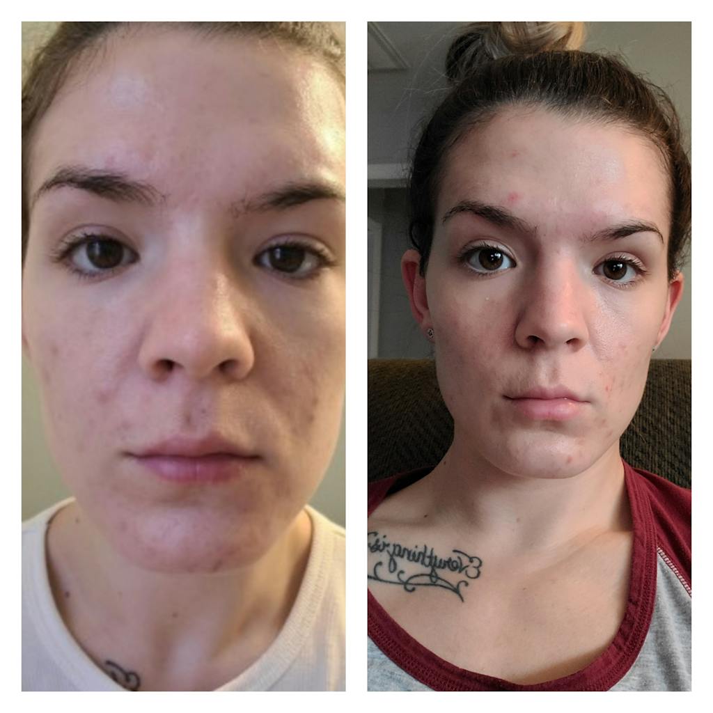 Pumpkin Enzyme Mask Top Rated Natural Acne Clearing Mask Banish