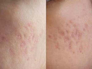 Scarring and Acne Kit