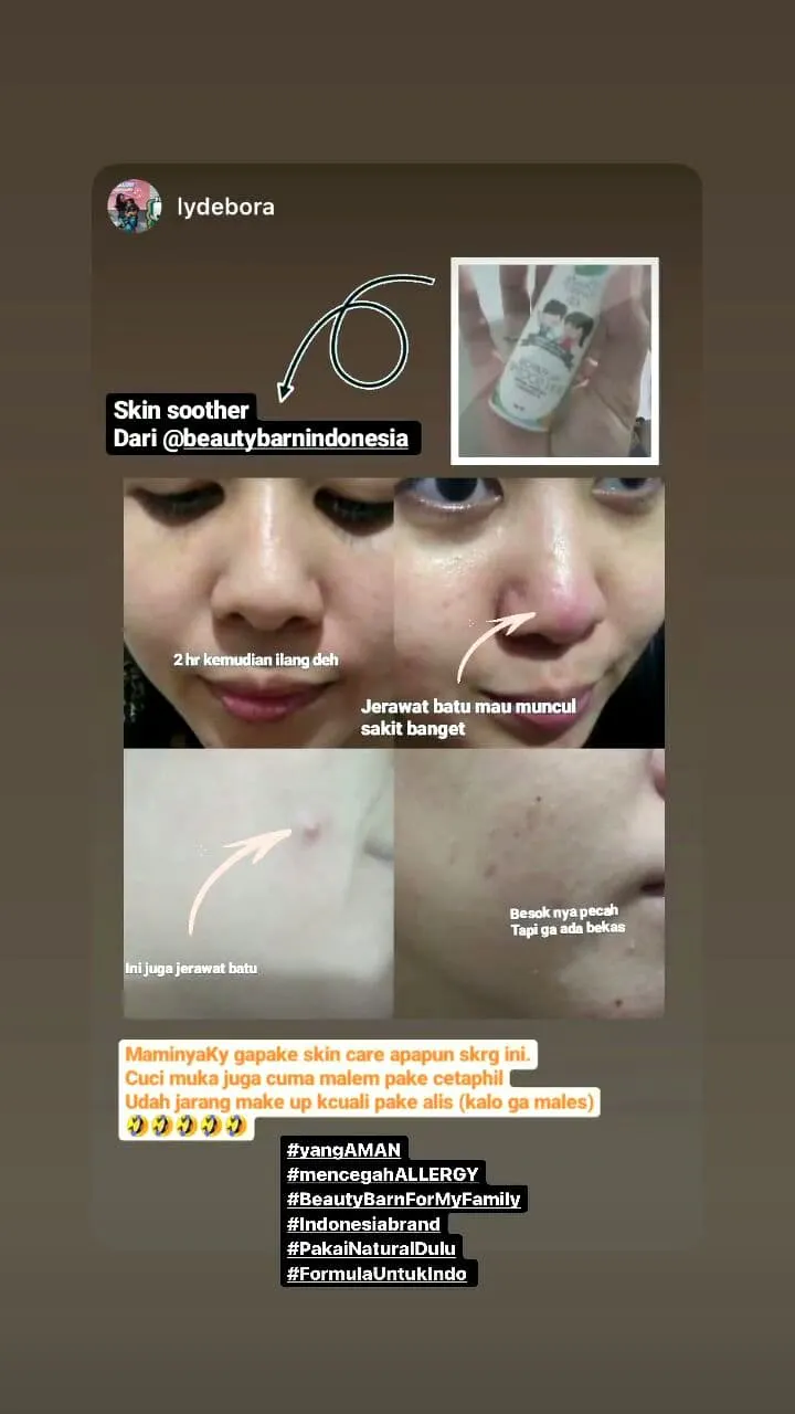 Jerawat Ga Sembuh Sembuh Beauty Barn Kid