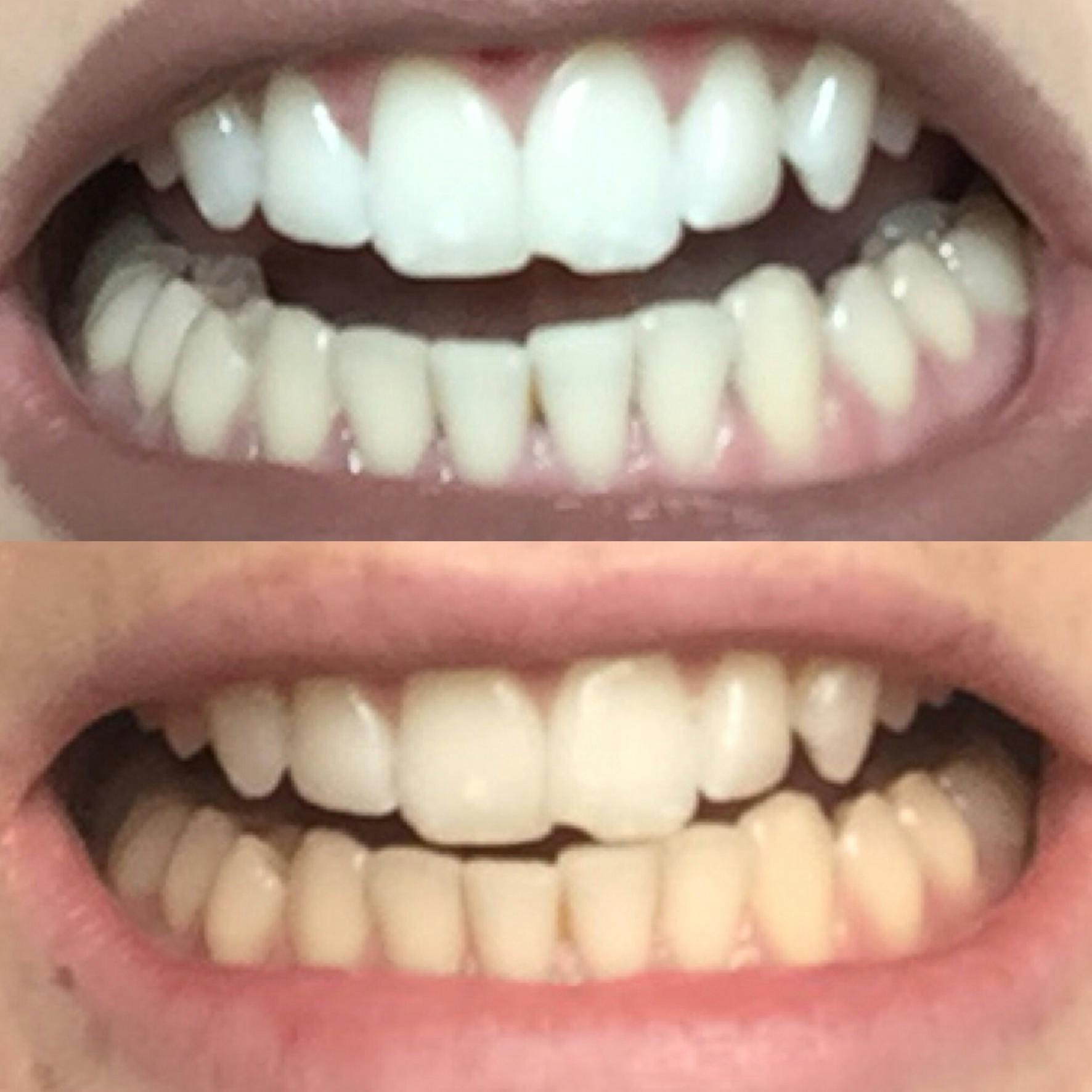 Teeth Kit Bianco | Highest Grade Gel