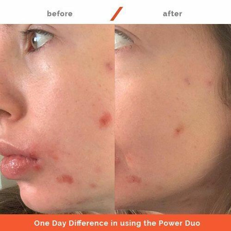 Acne Recovery Duo – Puppy Skincare