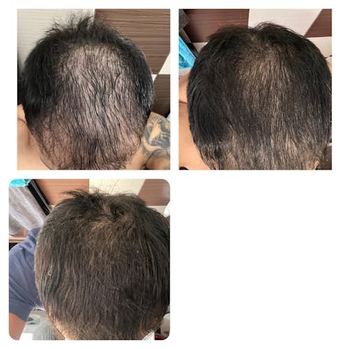 5 pcs Dermanewhair serum and Derma roller