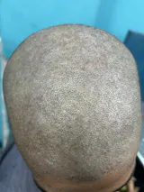 Folioxcin Anti-Dandruff Shampoo