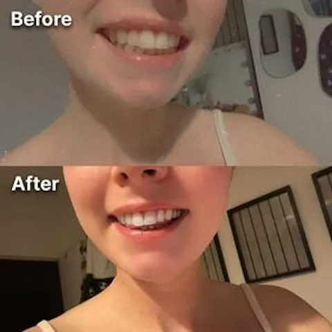Purple Teeth Whitening Strips