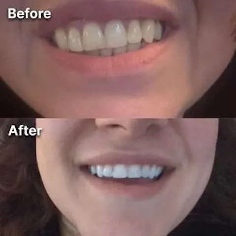 Purple Teeth Whitening Strips