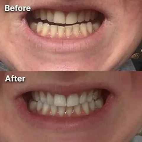 Purple Teeth Whitening Strips