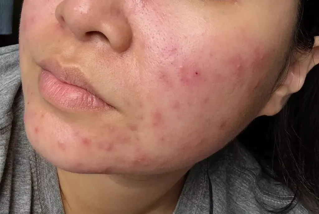 Dreamskin – #1 Acne Supplement Singapore | Probiotic for Clear Skin