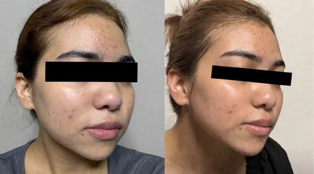 Golden Tomato Oral Sunblock Singapore - Best Skin Whitening Supplement | UV Protection, Brighten Skin & Fade Dark Spots