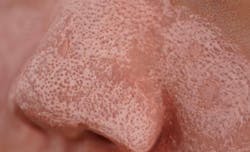 Shrink Poren Clay Pack