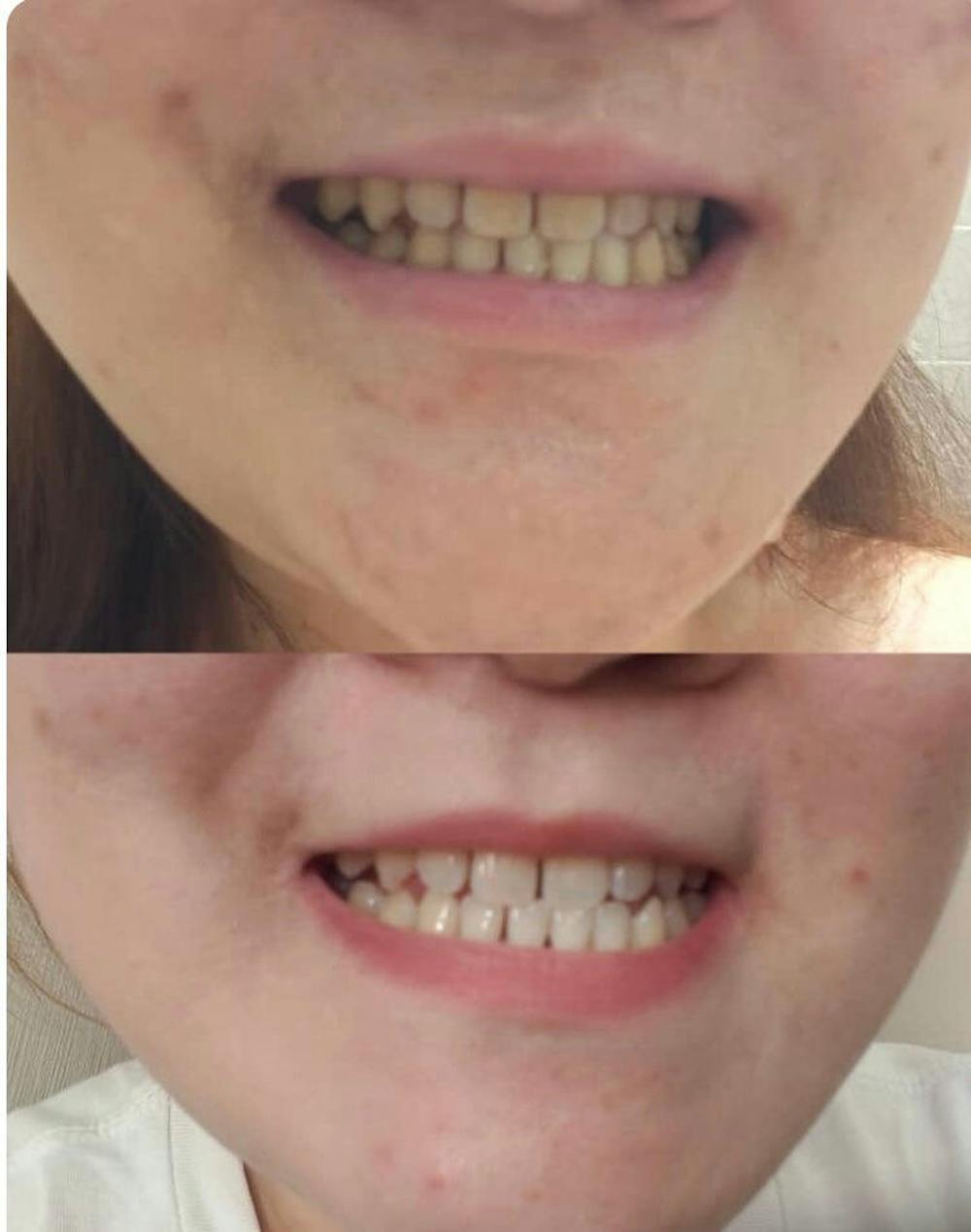 DRSMILE Complete Whitening Treatment