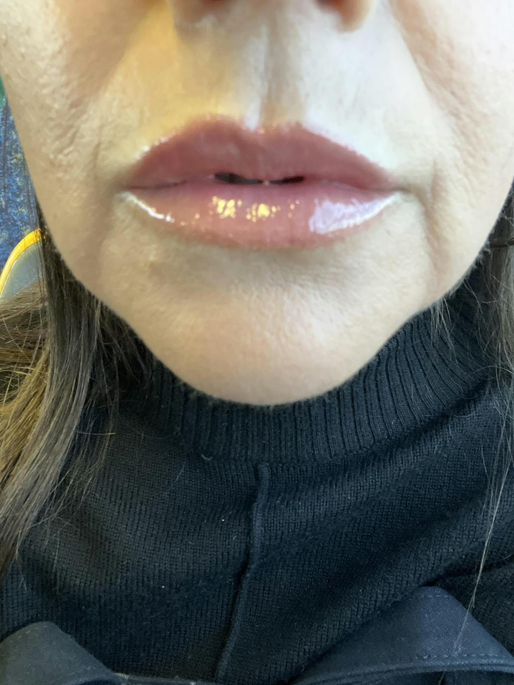 LIP INJECTION 10ml Freeze Frame Freezeframe