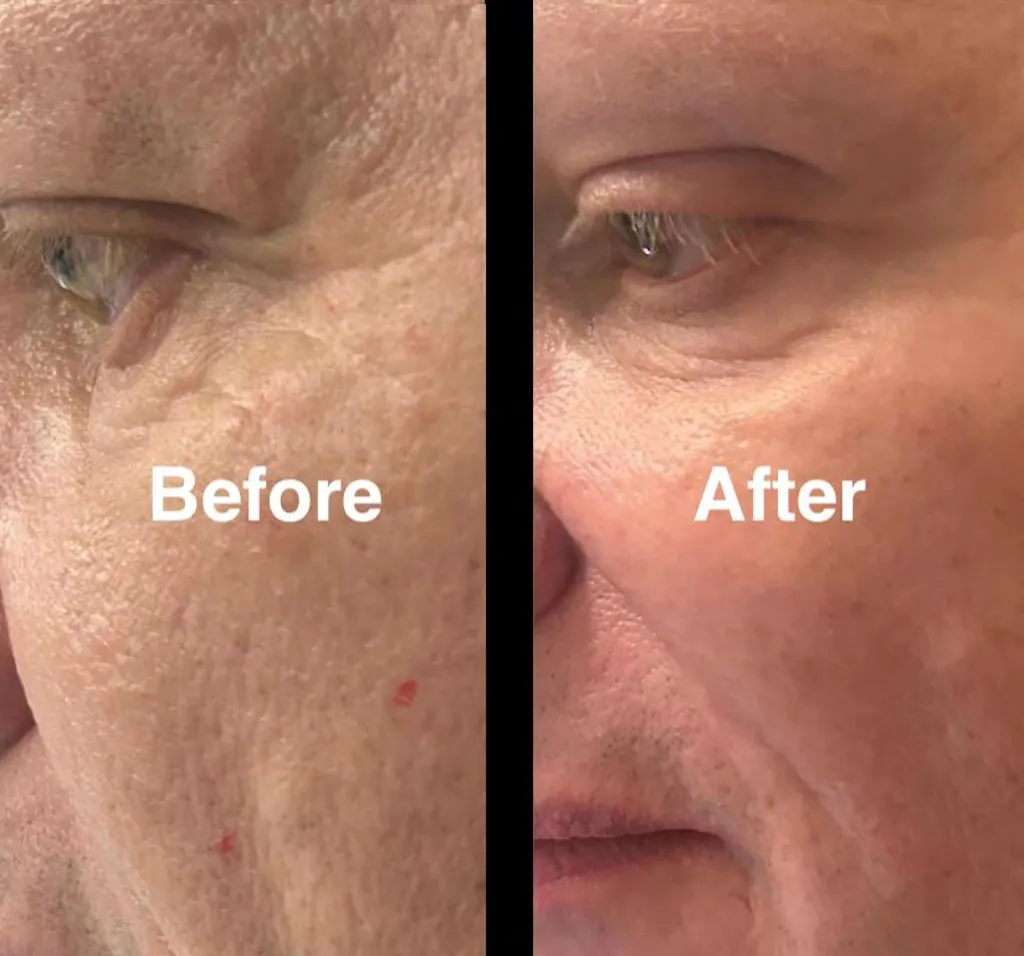 glutathione before and after face Essential Glutathione