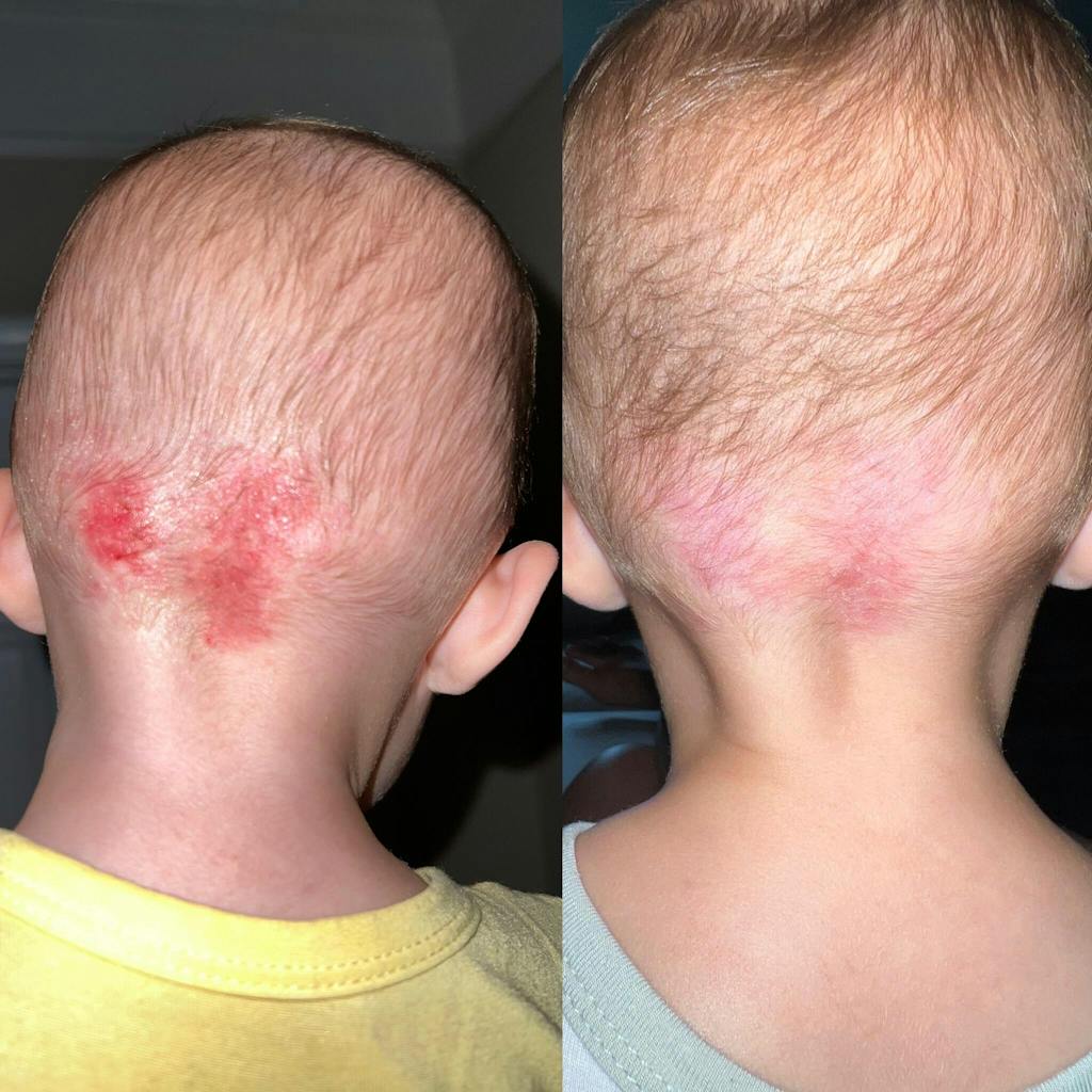 C+ Eczema & Dermatitis Cream Natural Eczema Cream Grahams Natural