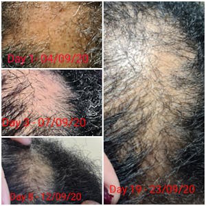 H.H Hair Follicle Stimulant - 100ml