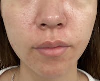 H-LAB Derma Touch Wireless 7 Color LED Mask Therapy