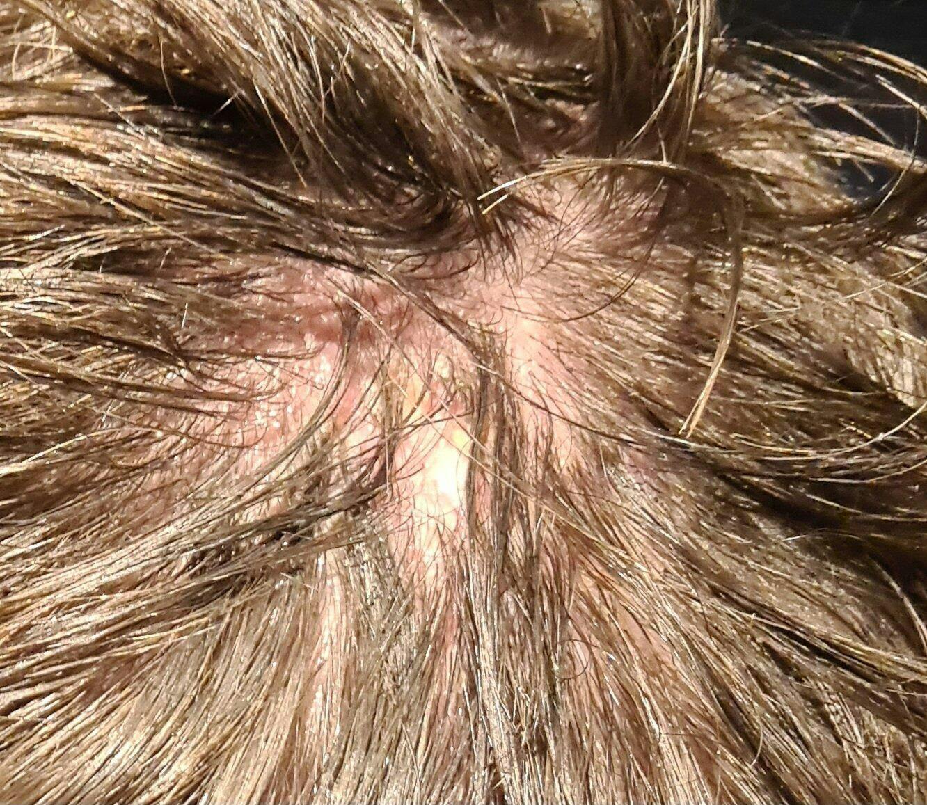 Seborrheic dermatitis scalp treatment - 15% discount - Hairgivers.com, image size:1332x1157