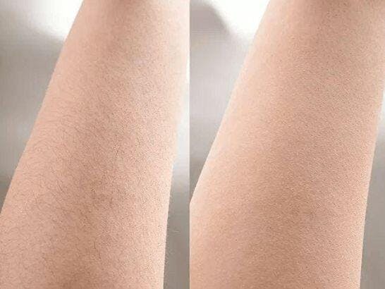 Lumishave hair removal