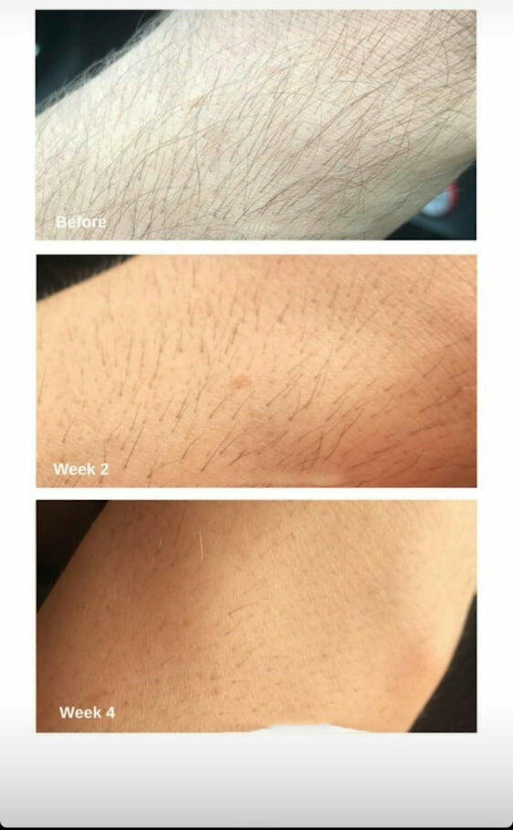 Hyper Sunk IPL Laser Hair Removal machine