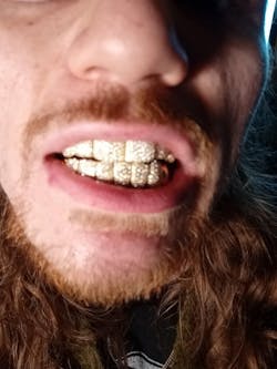 Custom End Capped Moissanite Grillz