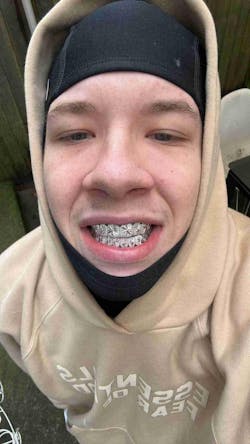 Custom Sunburst Cuts Grillz