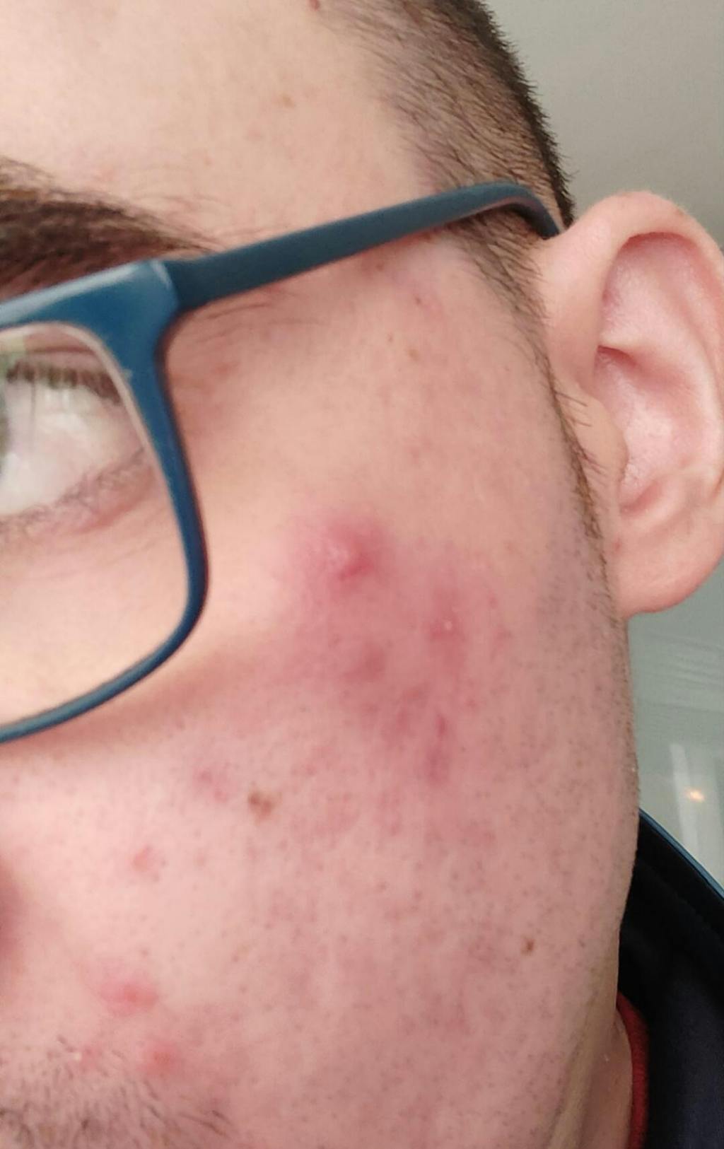 Jabón Herbal Natural con Lavanda y Arándano - para el Acné Corporal y la Piel Propensa a Imperfecciones