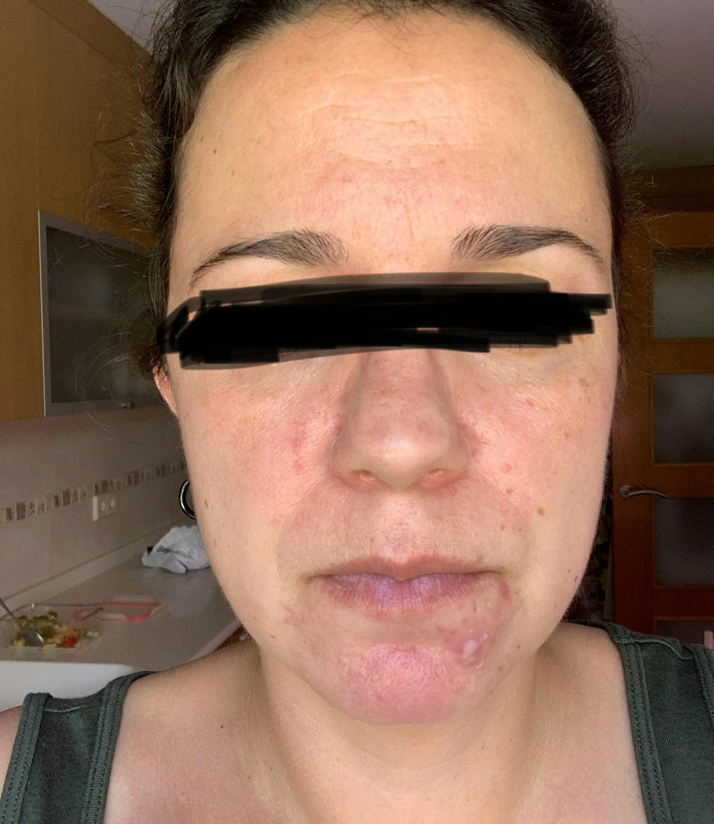 3x Hydrolina de lavanda para el acné
