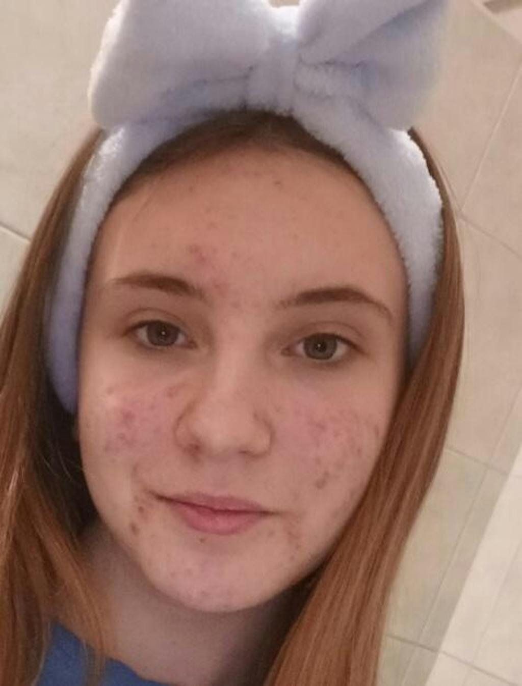 Organikus Levendula víz - Hydrolina Pattanásra