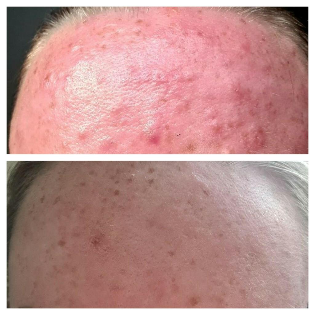 Organic Lavender water - Hydrolina for Acne