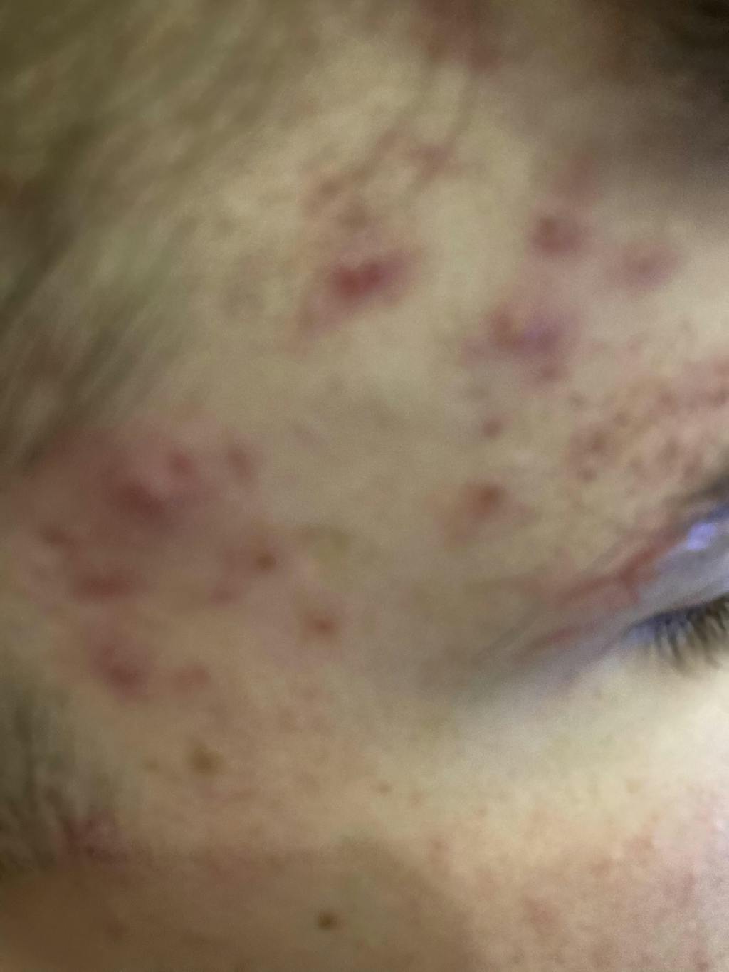 Hydrobiotic - Lavender & Mint - intensive care for Acne