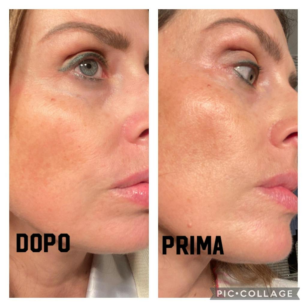 Acqua di Abete Bianco Bio - Hydrolina per l'Iperpigmentazione