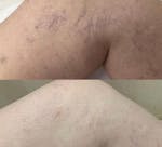 Remorrhoids - creme para Varizes e Hemorróidas - altamente enriquecido com Árvore do Fumo e Castanha de cavalo