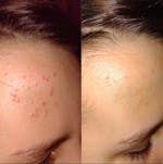 Hydrobiotic - Lavanda e Menta - cuidado intensivo para Acne