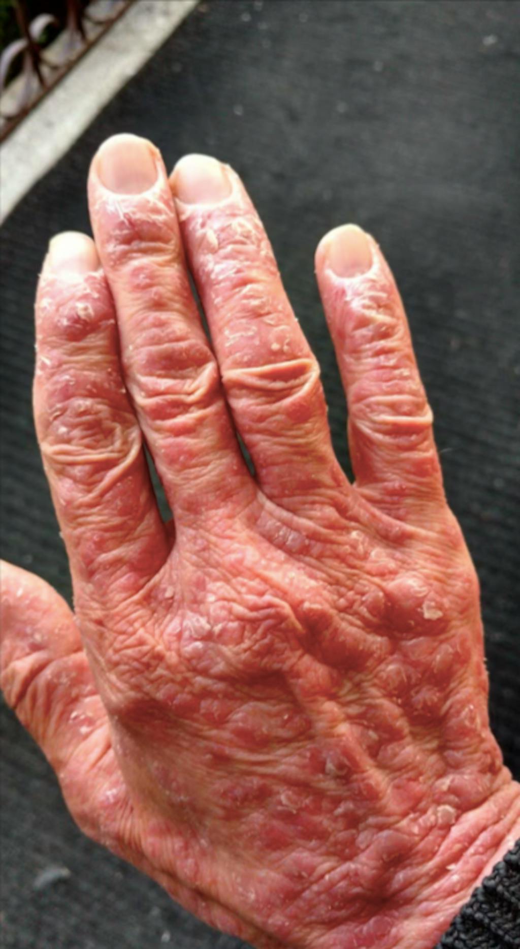 Apă de Sunătoare Sălbatică - Hydrolina pentru Psoriazis si piele Iritată