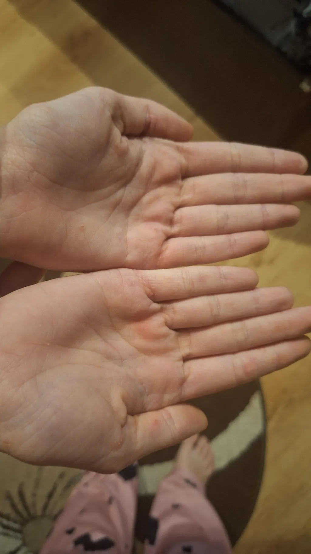 Cumpără 2 creme pentru psoriazis, eczeme și piele iritată și primești gratuit 1 apă organică de mușețel