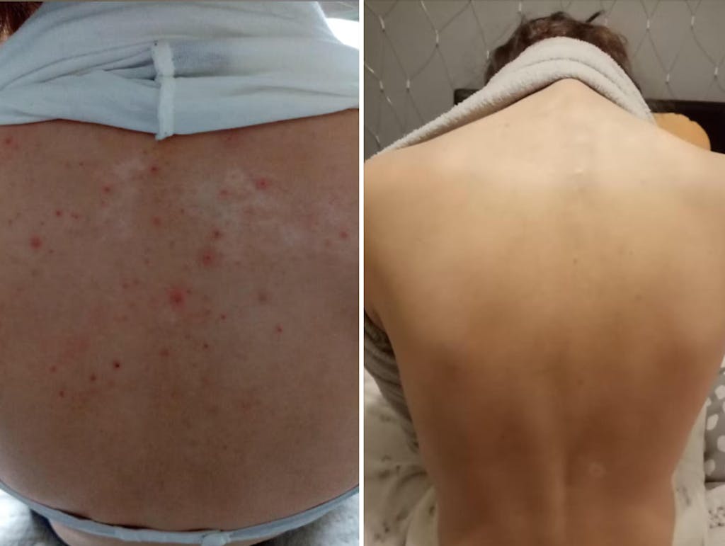 Eko Sivkina vodica - Hydrolina za Akne - Hidrolat Sivke