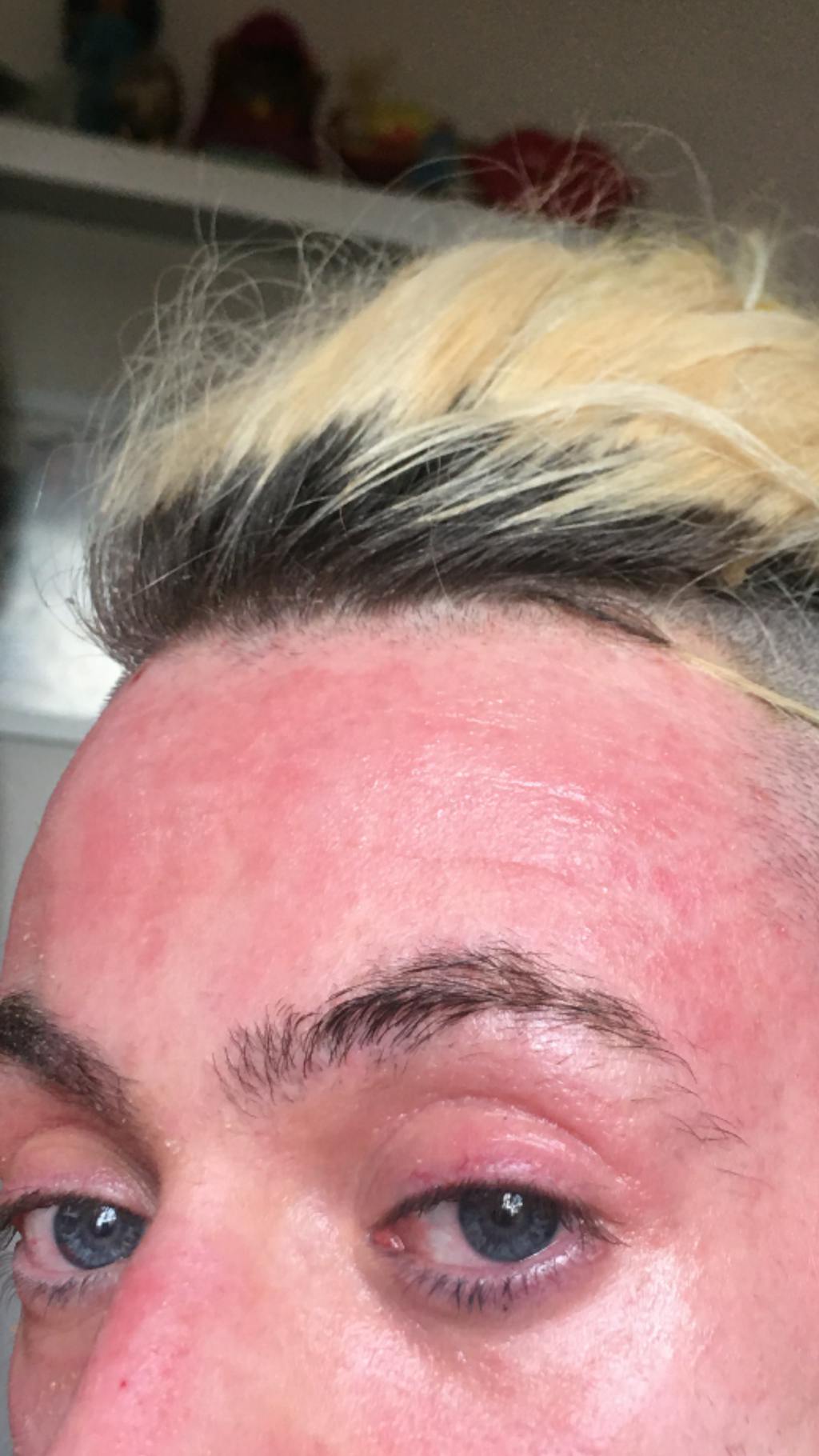 eczema-routina-eczema-skin-irritations-inaessentials-us
