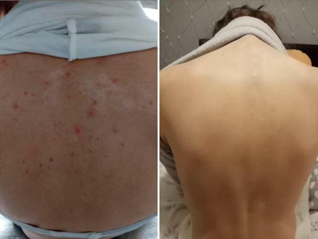 Organic Lavender water - Hydrolina for Acne