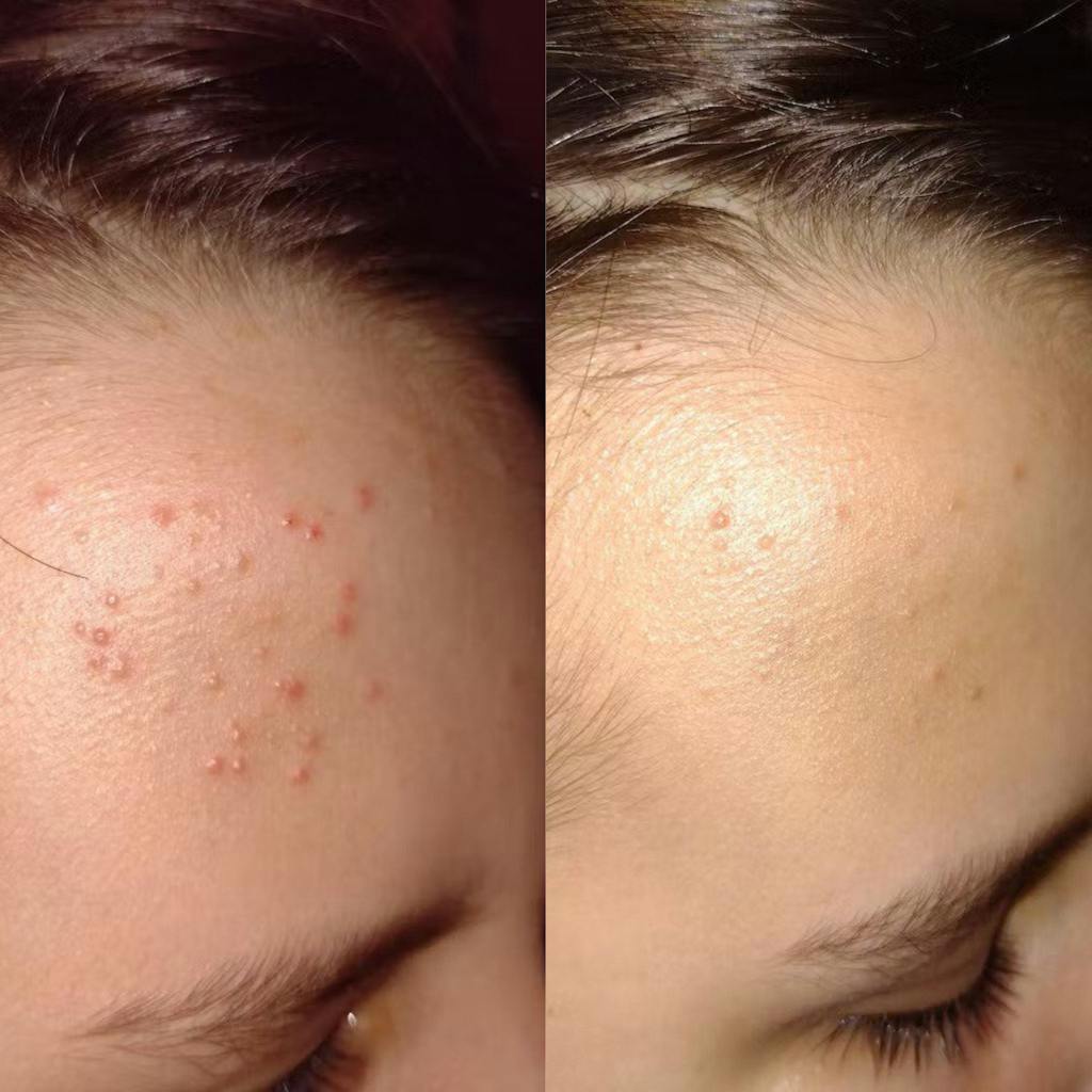 Organic Lavender water - Hydrolina for Acne