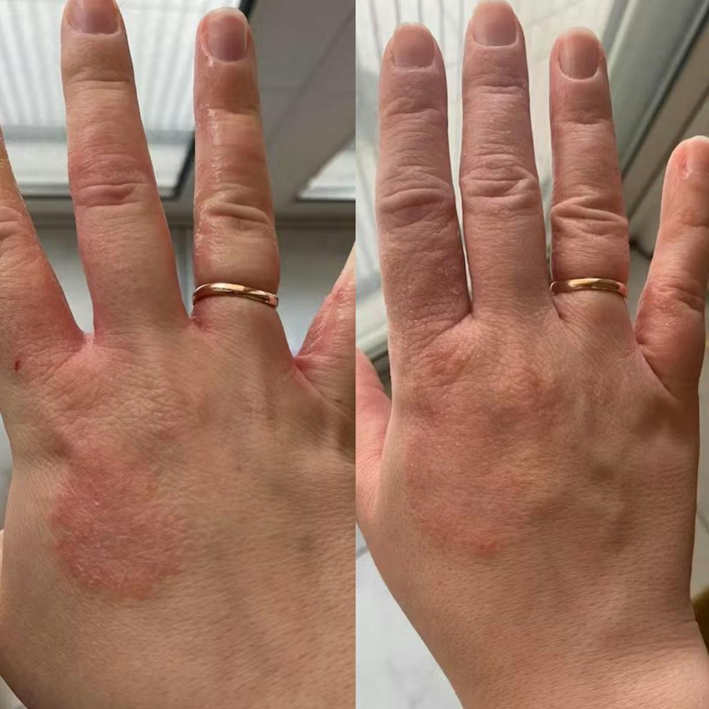 Organic Chamomile water - Hydrolina for Eczema and Irritated skin