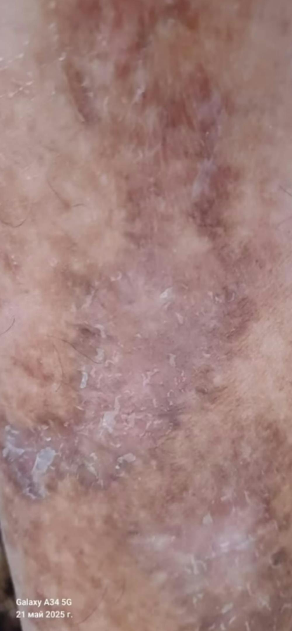 Remorrhoids - κρέμα για Κιρσούς και Αιμορροΐδες - εμπλουτισμένη με Χρυσόξυλο και αγριοκάστανο