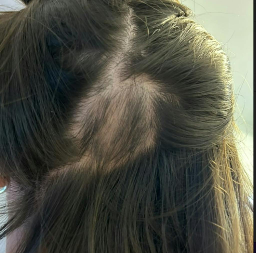 Tριχόπτωση RoutINA™ για Εκείνη - λύση που διαρκεί για την Tριχόπτωση