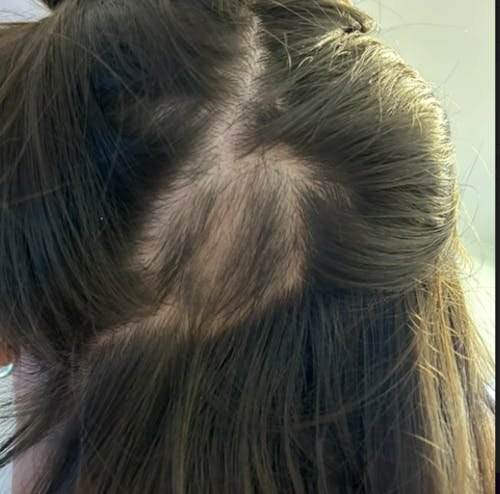 Tριχόπτωση RoutINA™ για Εκείνη - λύση που διαρκεί για την Tριχόπτωση