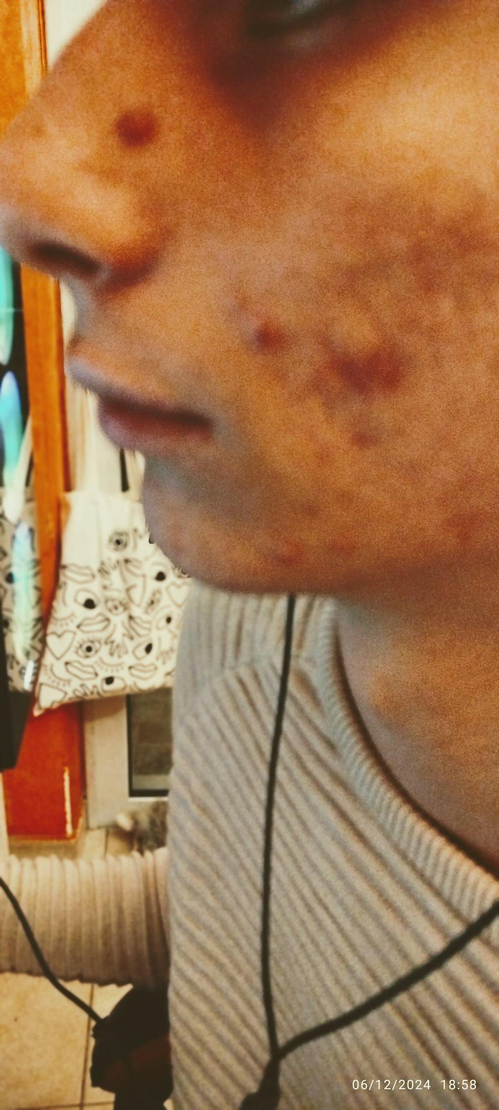 Οργανικό νερό Λεβάντας - Hydrolina για την Ακμή